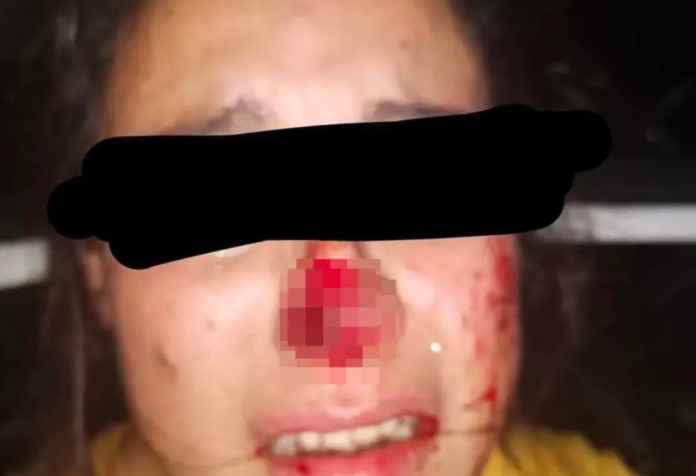 “Me quiso ahorcar, después me arrancó la nariz”: mujer agredida en Veracruz