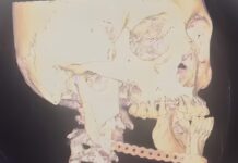 Reconstruyen mandíbula con tecnología 3D en Hospital del IMSS en Veracruz