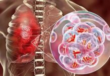 IMSS Veracruz Sur lanza alerta: Detección temprana, la clave para frenar la tuberculosis