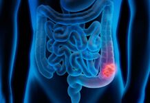 Prevención del Cáncer de Colon: Llamado del IMSS Veracruz Sur